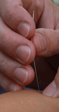 Bild Akupunktur